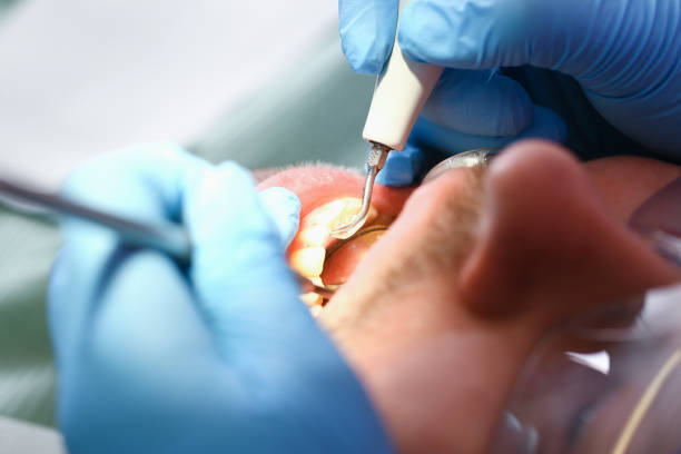 Best Emergency Wisdom Teeth Removal in Colquitt, GA